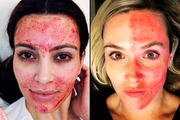 WHAT IS A PRP VAMPIRE FACELIFT 3 liquivida lounge.jpg