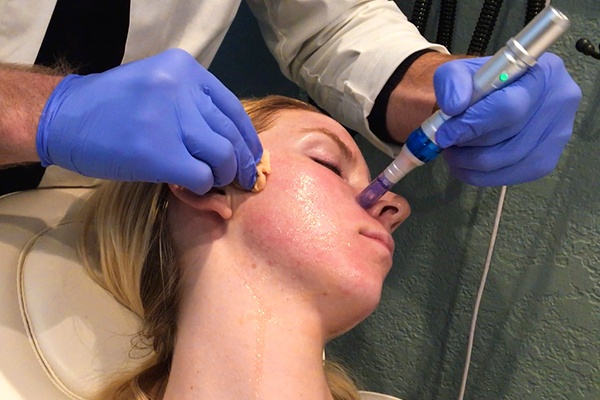 WHAT IS A PRP VAMPIRE FACELIFT 4 liquivida lounge.jpg