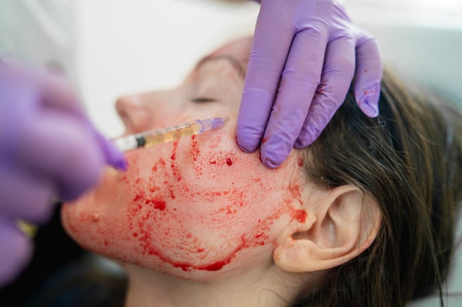 PRP Facial