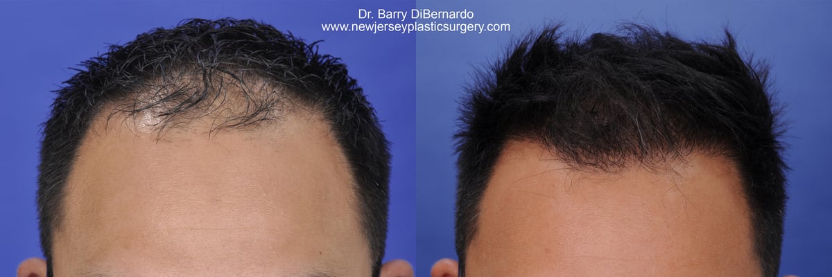 SmartGraft Before After Watermark 11