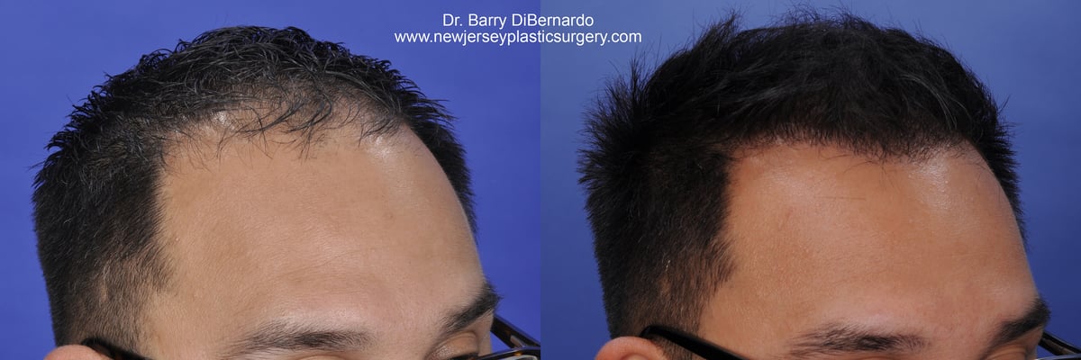 SmartGraft Before After Watermark 12