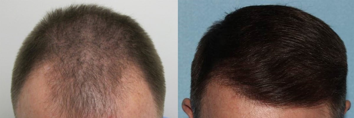 SmartGraft Before After Watermark 14