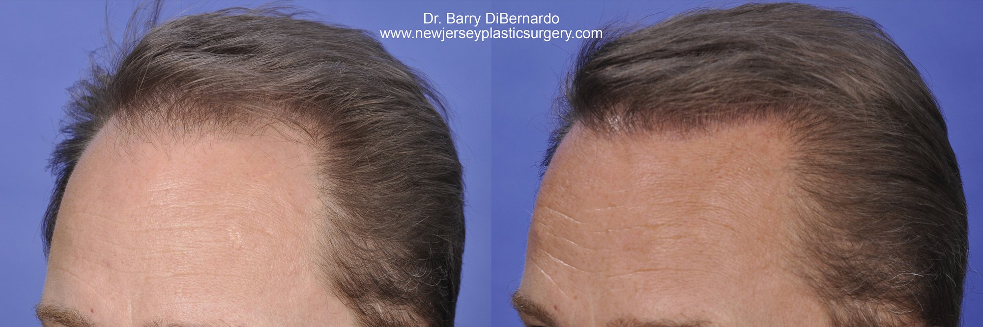 SmartGraft Before After Watermark 7