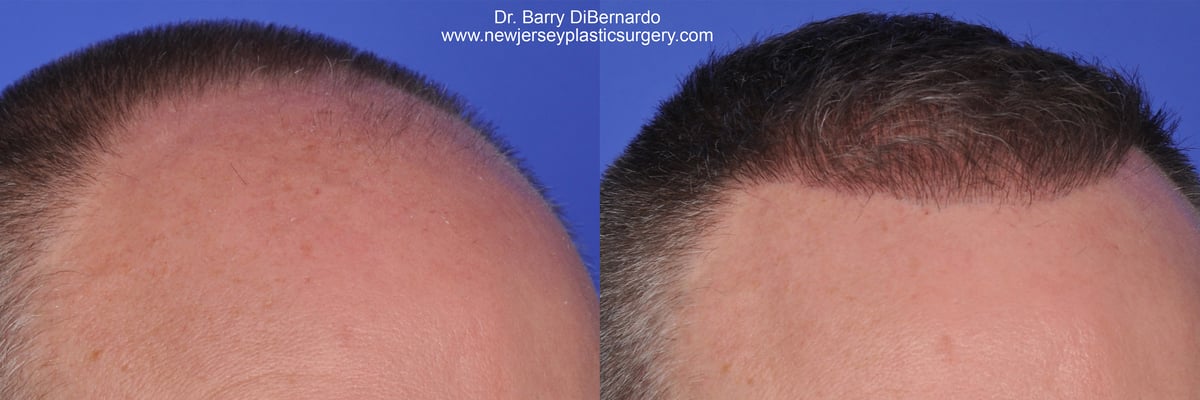 SmartGraft Before After Watermark 8