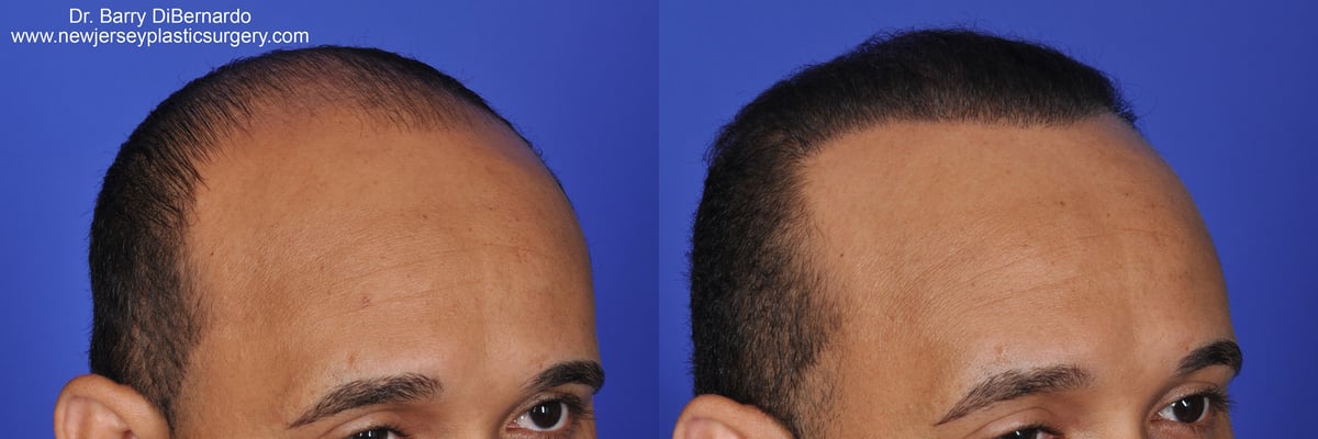 SmartGraft Before After Watermark 9