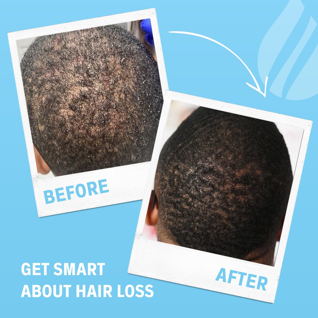 Get smart about hair loss post