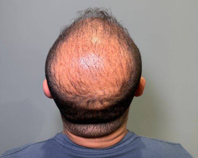 Hair Loss in Male