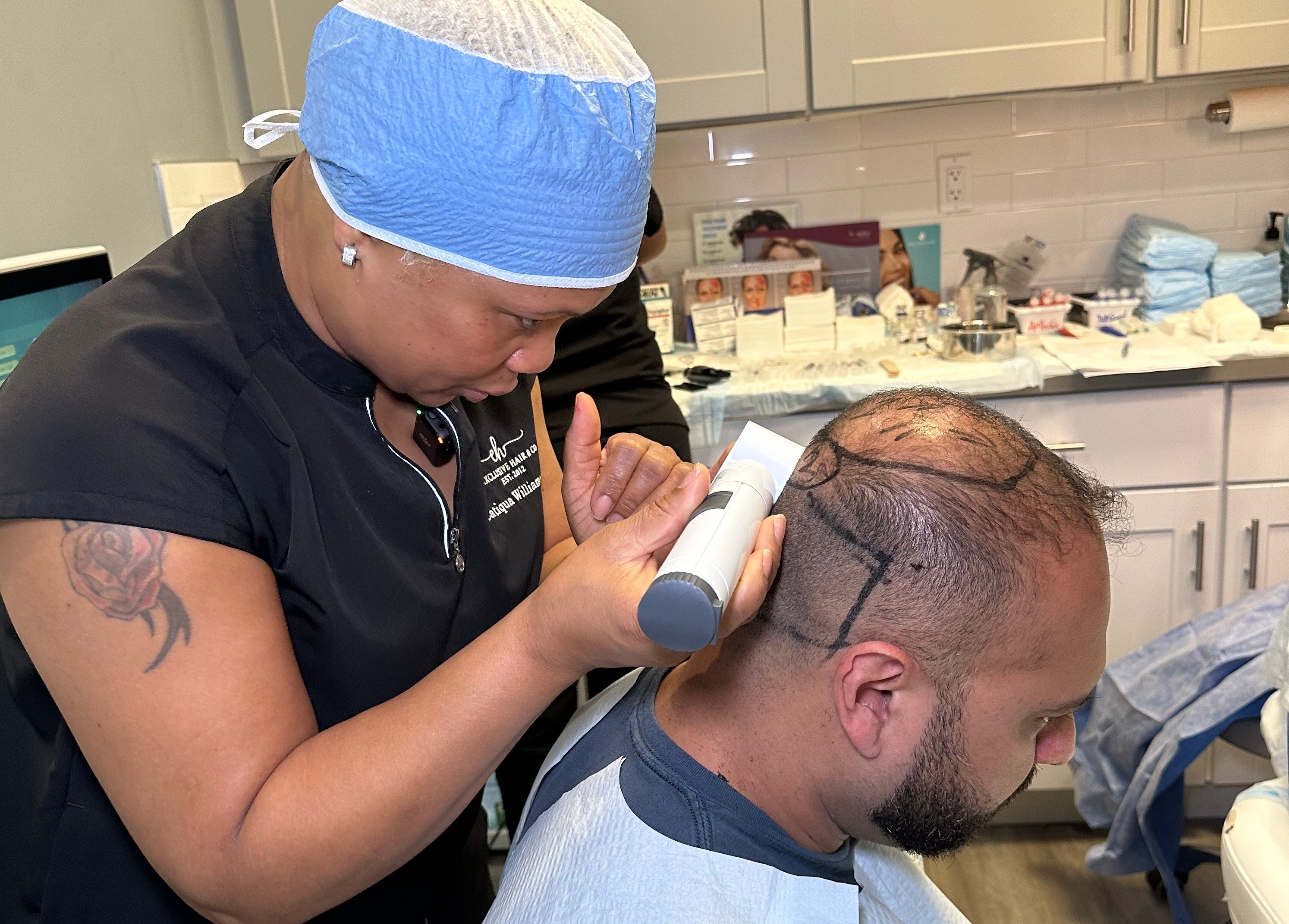 What Is SmartGraft Hair Restoration