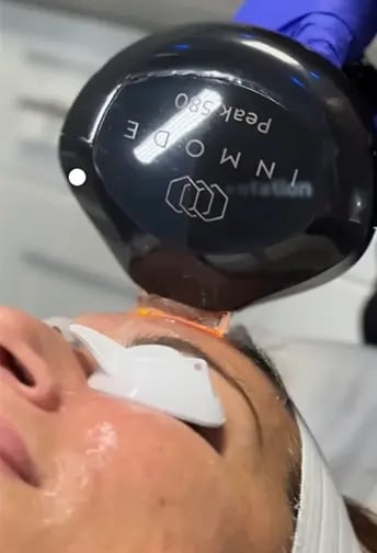 Close up of a patient's face getting a laser skin treatment at Liquivida Middletown
