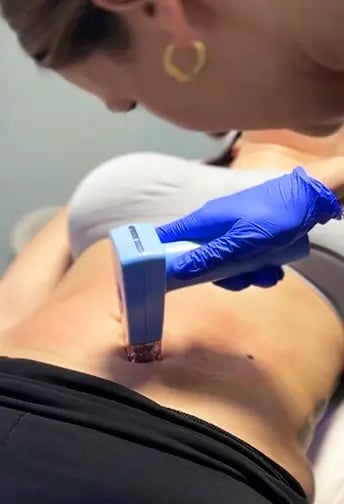Close up of a patient's abs getting a laser skin treatment at Liquivida Middletown