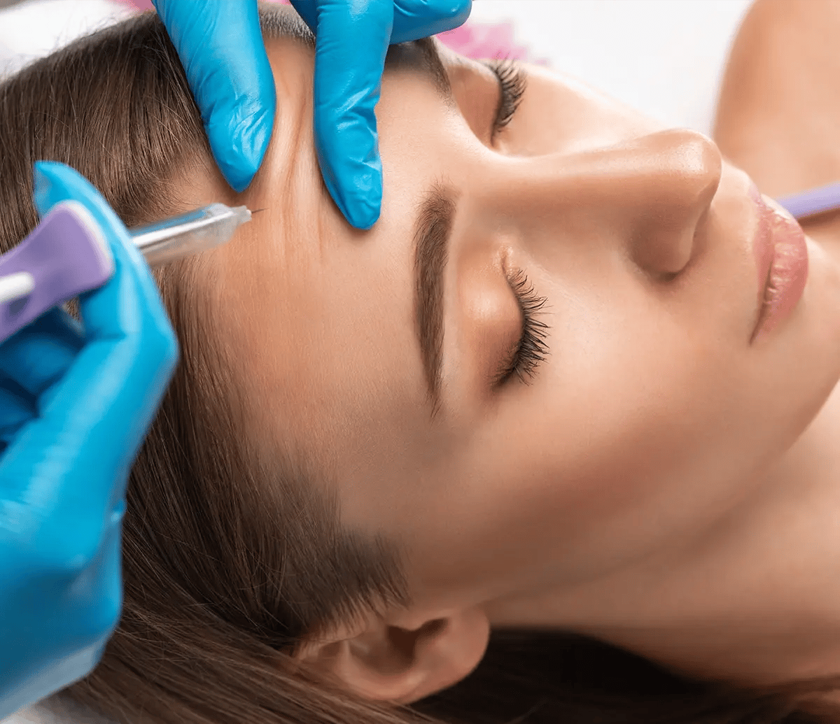 Woman gets a Revanesse injection on her forehead at Liquivida