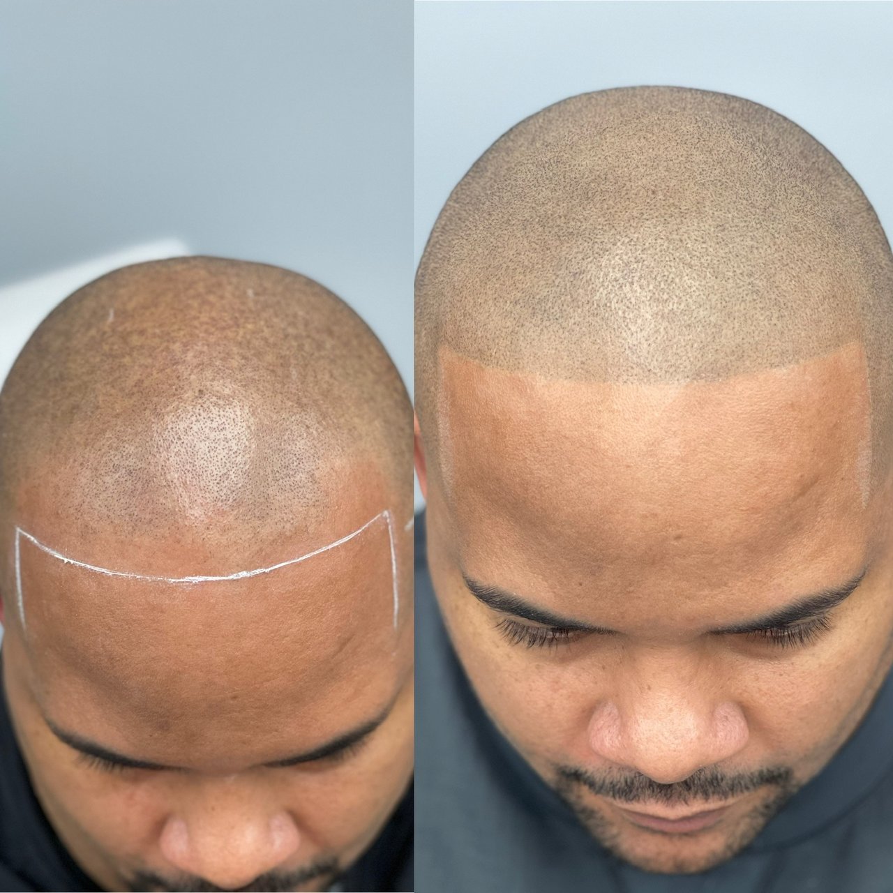 Scalp Micropigmentation