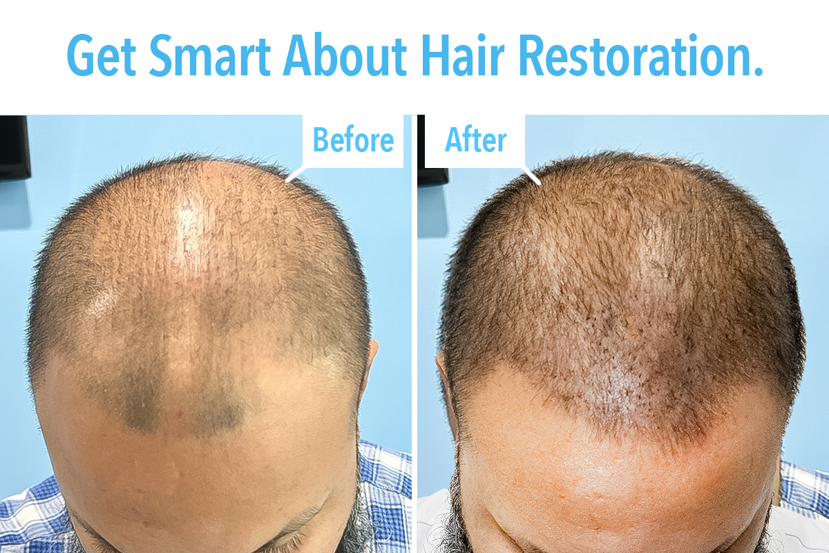 Liquivida® user before and after using SmartGraft® for hair restoration. 