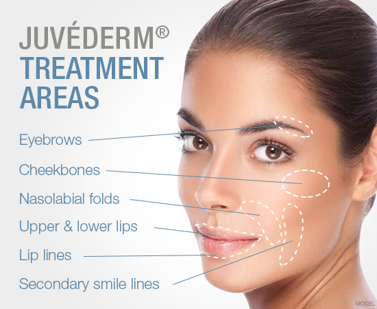 Juverderm-Image-1